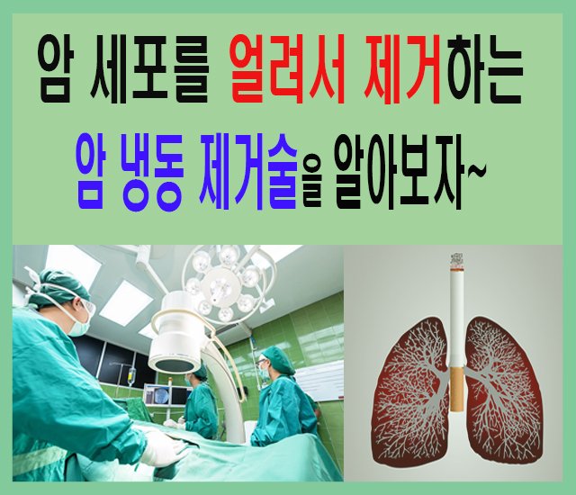 [건강 #4] 암 세포를 얼려서 제거하는 '암 냉동제거술'을 알아보자.jpg